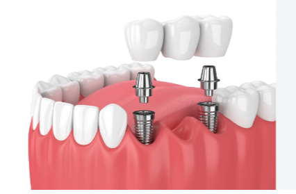İki implant üzerine yerleştirilen köprü