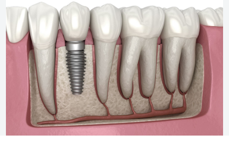 Çene kemiğine yerleştirilmiş tek diş implantı ve kronu