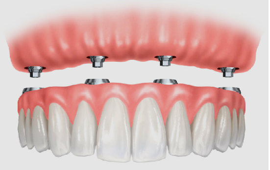 Üst ve alt çenede implantlara bağlanan sabit protezler